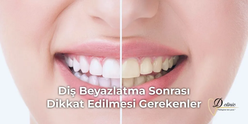 dis-beyazlatma-sonrasi-dikkat-edilmesi-gerekenler-min