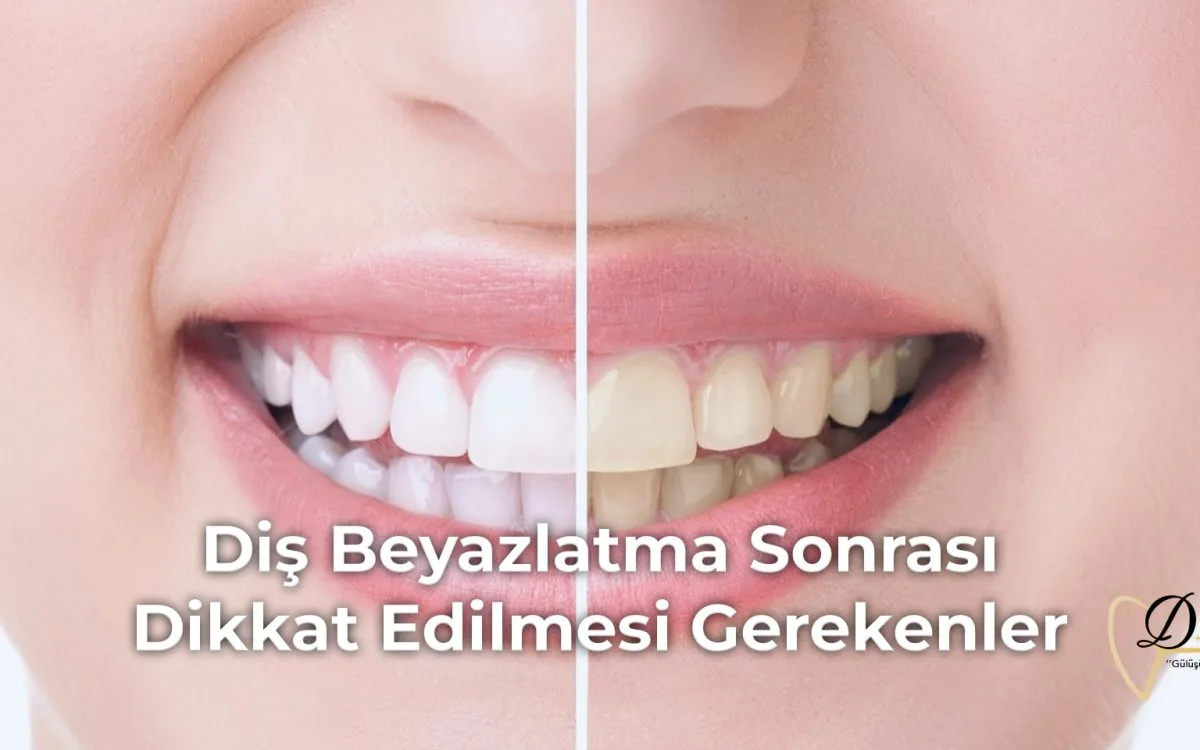 dis-beyazlatma-sonrasi-dikkat-edilmesi-gerekenler-min