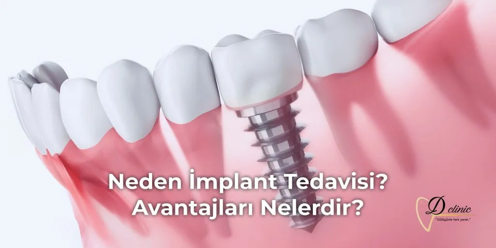 neden-implant-tedavisi-avantajlari-nelerdir-min
