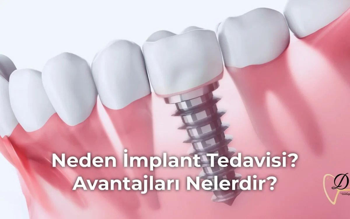 neden-implant-tedavisi-avantajlari-nelerdir-min